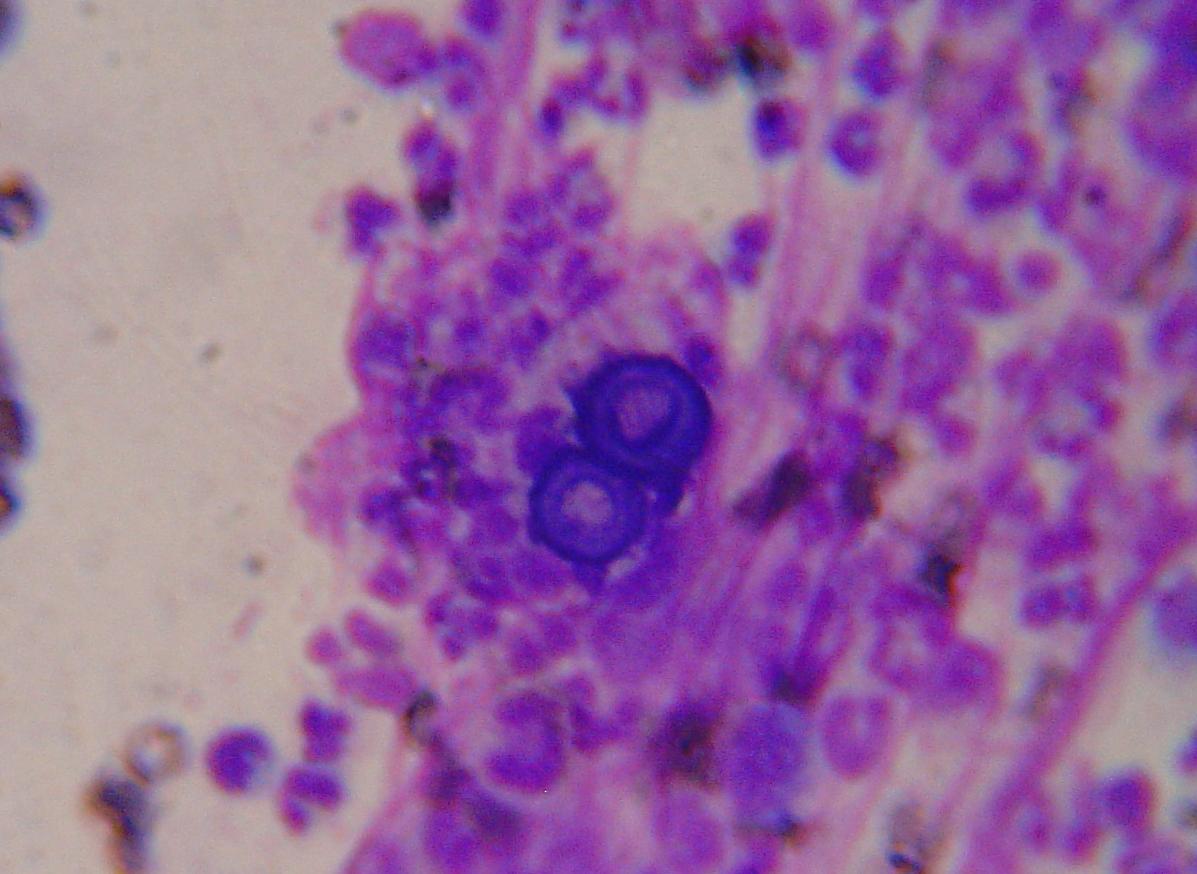Blastomyces dermatitidis