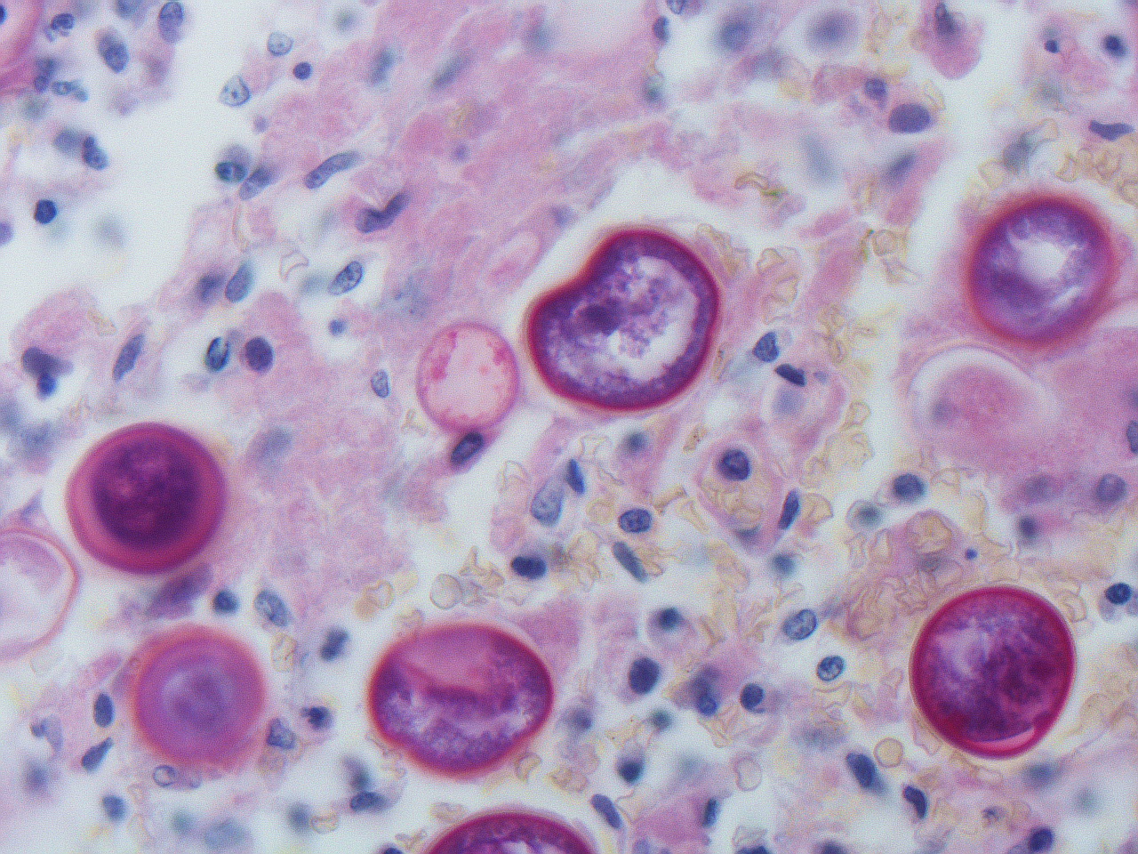 Coccidioides posadasii